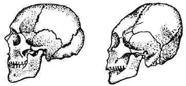 Деформированный череп (справа) в сравнении с недеформированным по Т. Сулимскому 